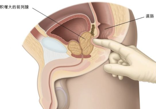 慢性前列腺炎 中医食疗防治前列腺炎