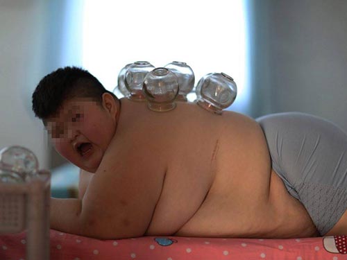 拔罐减肥2.jpg