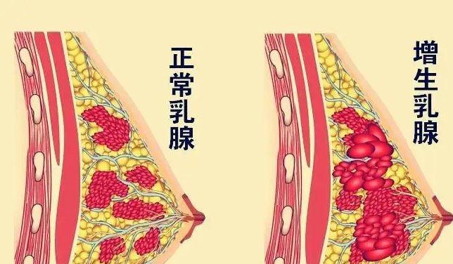 乳腺增生如何治 中药治疗乳腺增生效果好