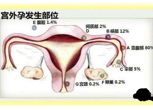 什??原因导致宫外孕？