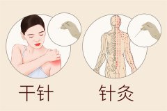 什么是针灸疗法 针灸疗法原理与效果