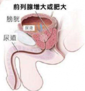前列腺影响早泄么？前列腺的并发