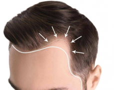 男人掉头发是什么原因引起的？