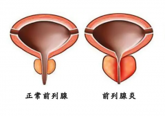前列腺炎怎么治疗？苹果缓解前列