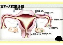 什么原因导致宫外孕？