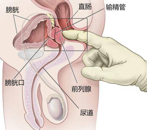 前列腺炎如何进行自我保健？
