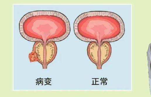 前列腺炎怎么治疗？治疗前列腺炎