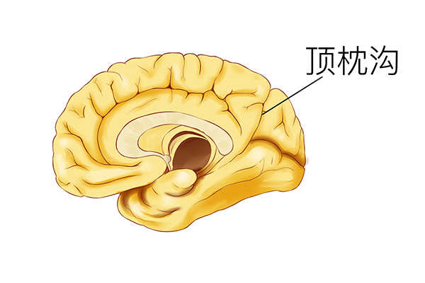 脑雾是什么症状