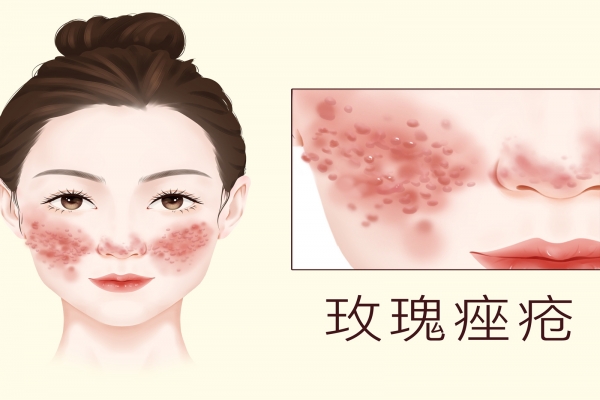 北京治疗痤疮哪家医院好