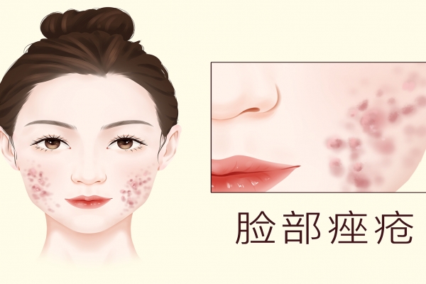 北京治疗痤疮哪家医院好