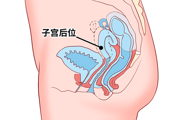子宫前位是好事还是坏事
