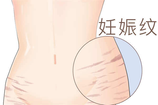 肚子上妊娠纹怎么去
