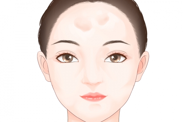 额头中间有点凹进去怎么办