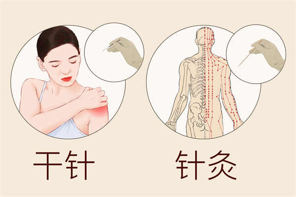 什么是针灸疗法