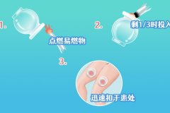 拔火罐的坏处 拔火罐的潜在风险