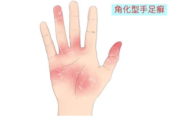 手足癣的症状和治疗方法