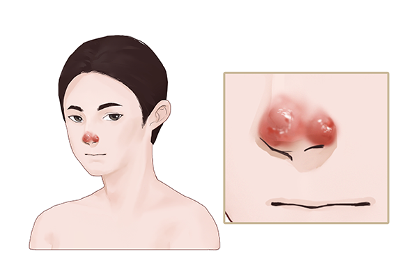 肉芽肿是什么样子的