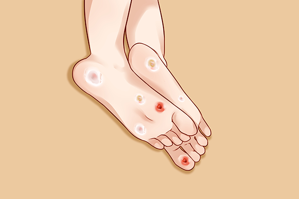 鸡眼传染吗