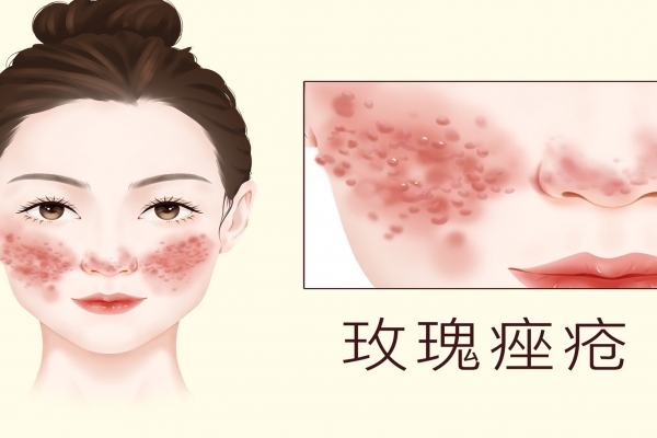 治疗痤疮哪家医院好