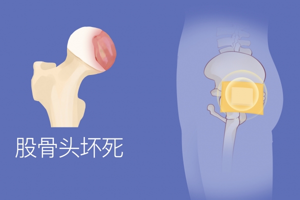 治疗股骨头坏死哪家医院好