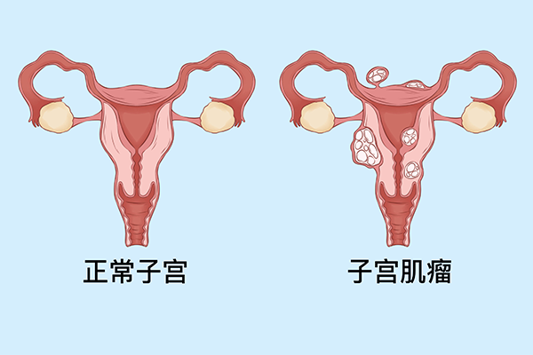 子宫肌瘤怎么治最好