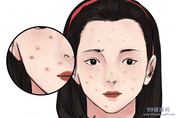 黑色痘印怎么消除