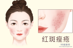 中药治痤疮好还是西药好 中药与