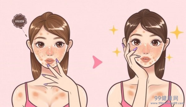 最佳的中药祛斑方子 祛斑效果最