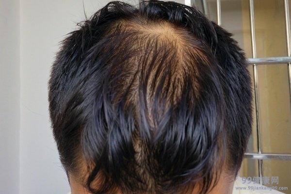 男性脱发该如何预防 男性预防脱