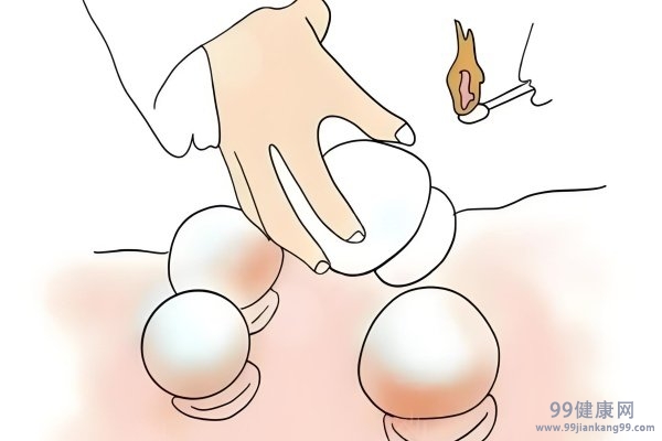 拔火罐有哪些好处和坏处 拔火罐