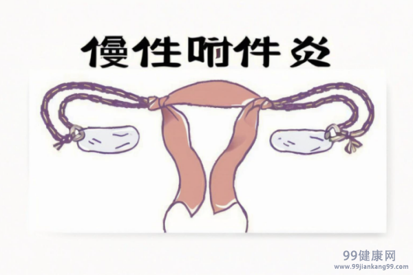 附件炎的症状 附件炎是什么原因