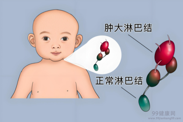 淋巴结炎症状 淋巴结炎有哪些表